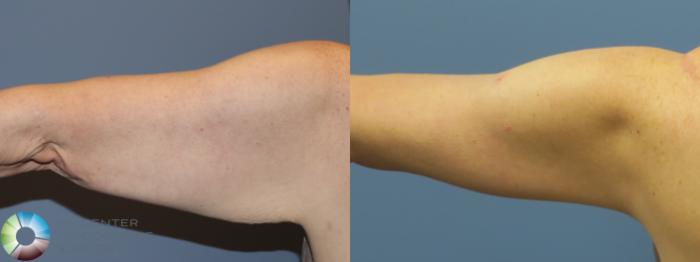 Before & After Arm Lift Case 11775 Left Posterior in Denver, CO