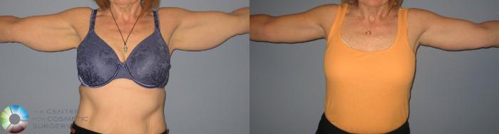 Before & After Arm Lift Case 441 View #1 in Denver, CO