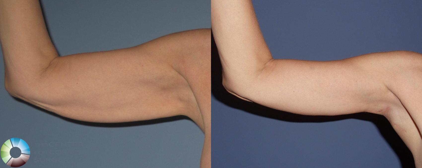 Before & After Arm Lift Case 442 View #1 in Denver and Colorado Springs, CO