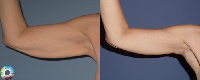 Before & After Arm Lift Case 442 View #1 in Denver, CO