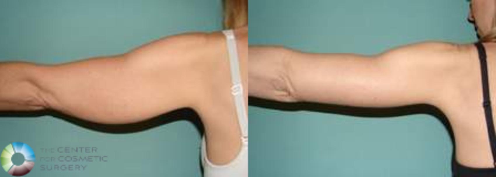 Before & After Arm Lift Case 628 View #1 in Denver and Colorado Springs, CO
