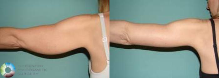 Before & After Arm Lift Case 628 View #1 in Denver, CO