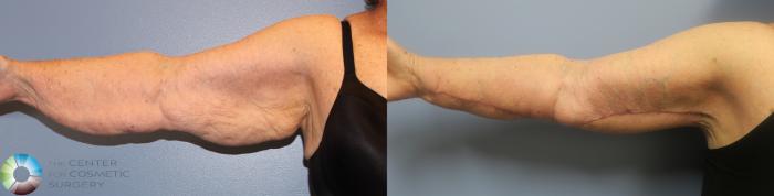 Before & After Arm Lift Case 839 View #1 in Denver, CO