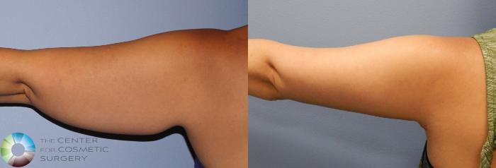 Before & After Arm Lift Case 886 View #1 in Denver, CO
