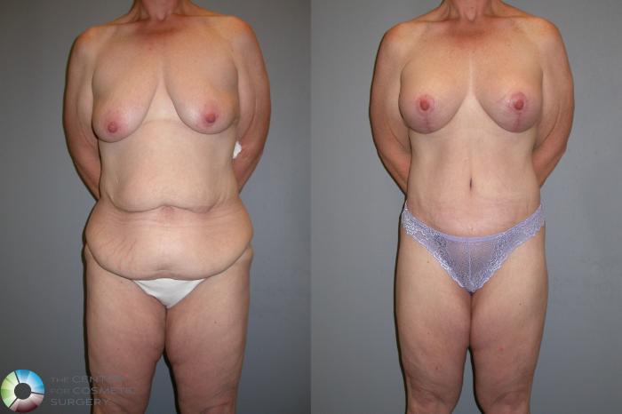 Before & After Buttock Lift Case 105 View #1 in Denver, CO