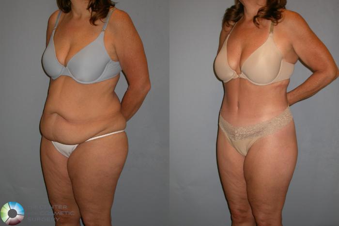Before & After Body Lift Case 110 View #1 in Denver and Colorado Springs, CO