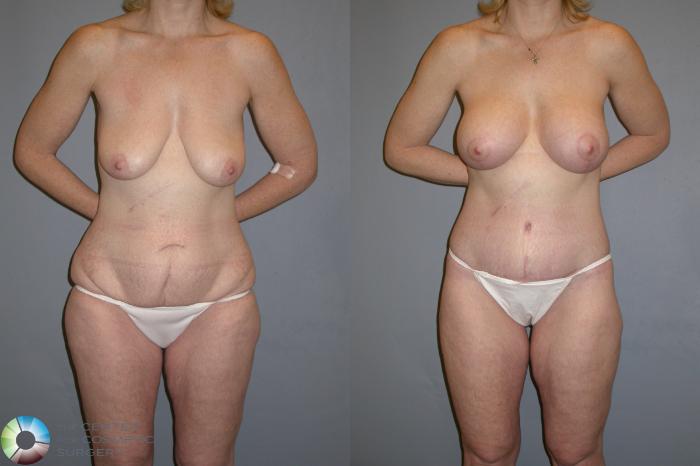 Before & After Thigh Lift Case 111 View #1 in Denver, CO