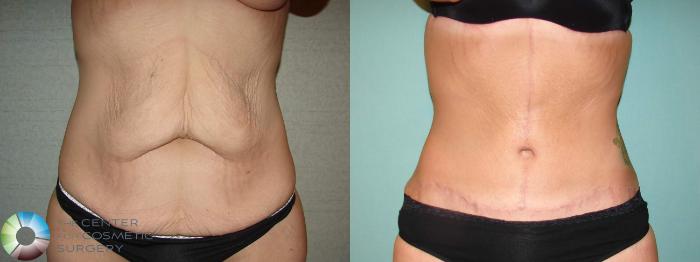 Before & After Body Lift Case 11939 Front in Denver and Colorado Springs, CO