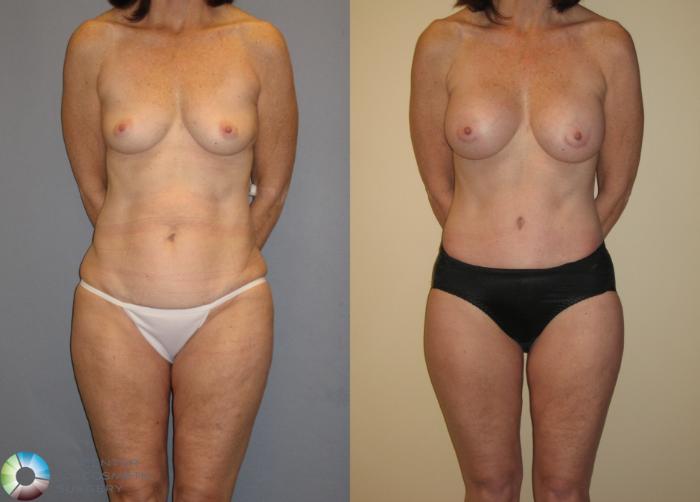 Before & After Thigh Lift Case 125 View #1 in Denver, CO