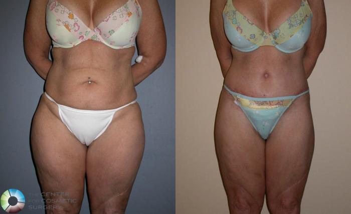 Before & After Body Lift Case 76 View #1 in Denver and Colorado Springs, CO