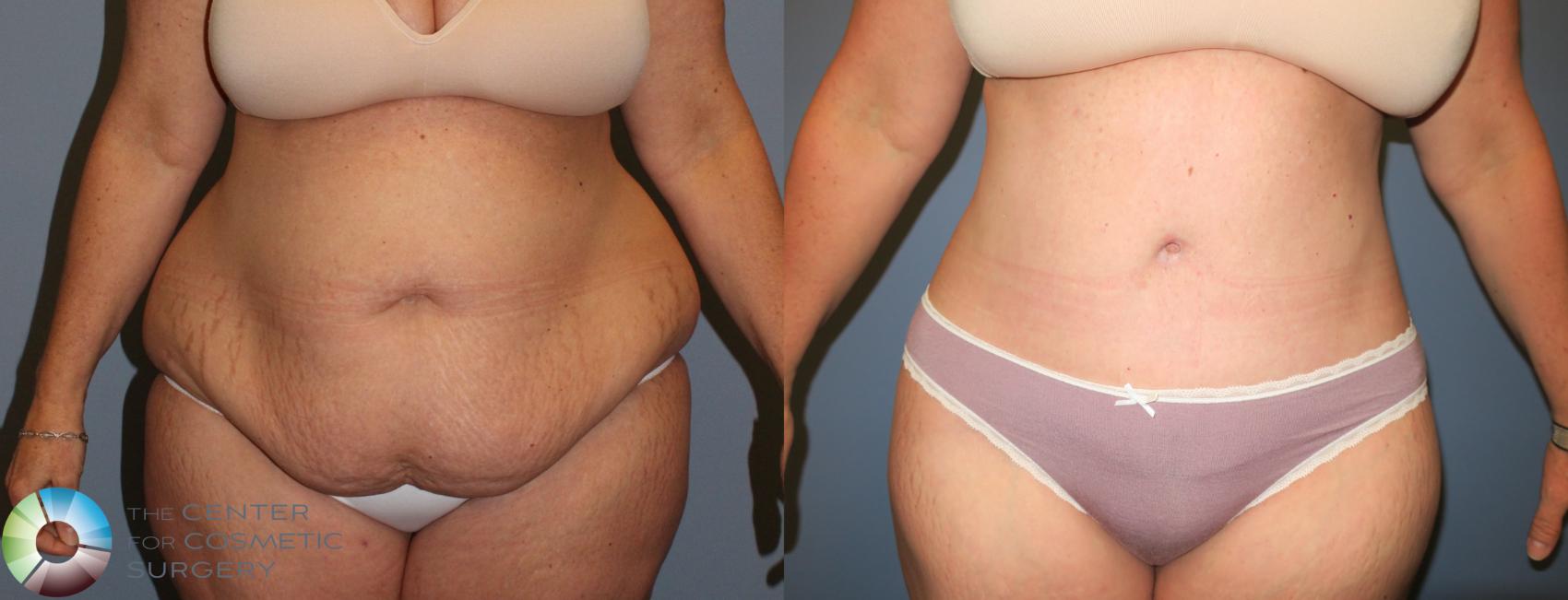 Before & After Body Lift Case 765 View #1 in Denver, CO