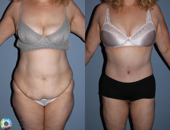Before & After Buttock Lift Case 785 View #1 in Denver, CO