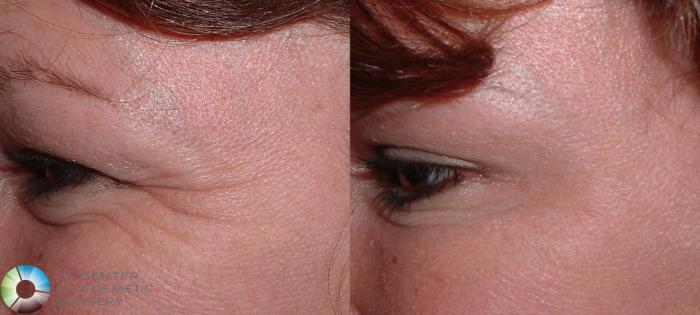 Before & After BOTOX® Cosmetic Case 158 View #1 in Denver, CO