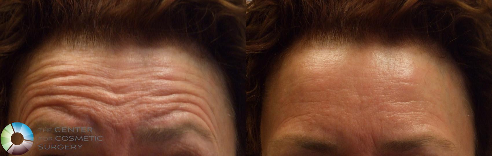 Before & After BOTOX® Cosmetic Case 279 View #1 in Denver and Colorado Springs, CO