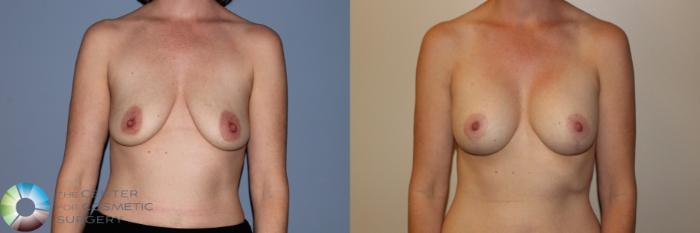Before & After Breast Lift Case 11499 Front in Denver, CO