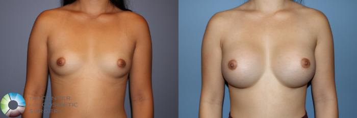 Before & After Breast Augmentation Case 11670 Front in Denver, CO