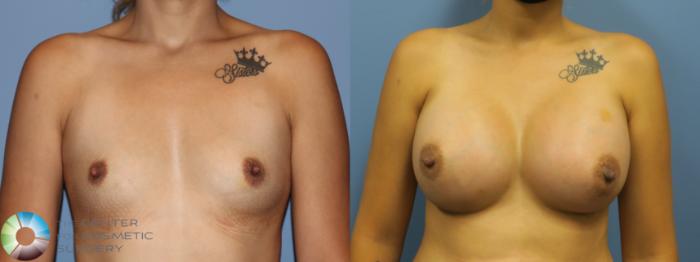 Before & After Breast Augmentation Case 11727 Front in Denver, CO