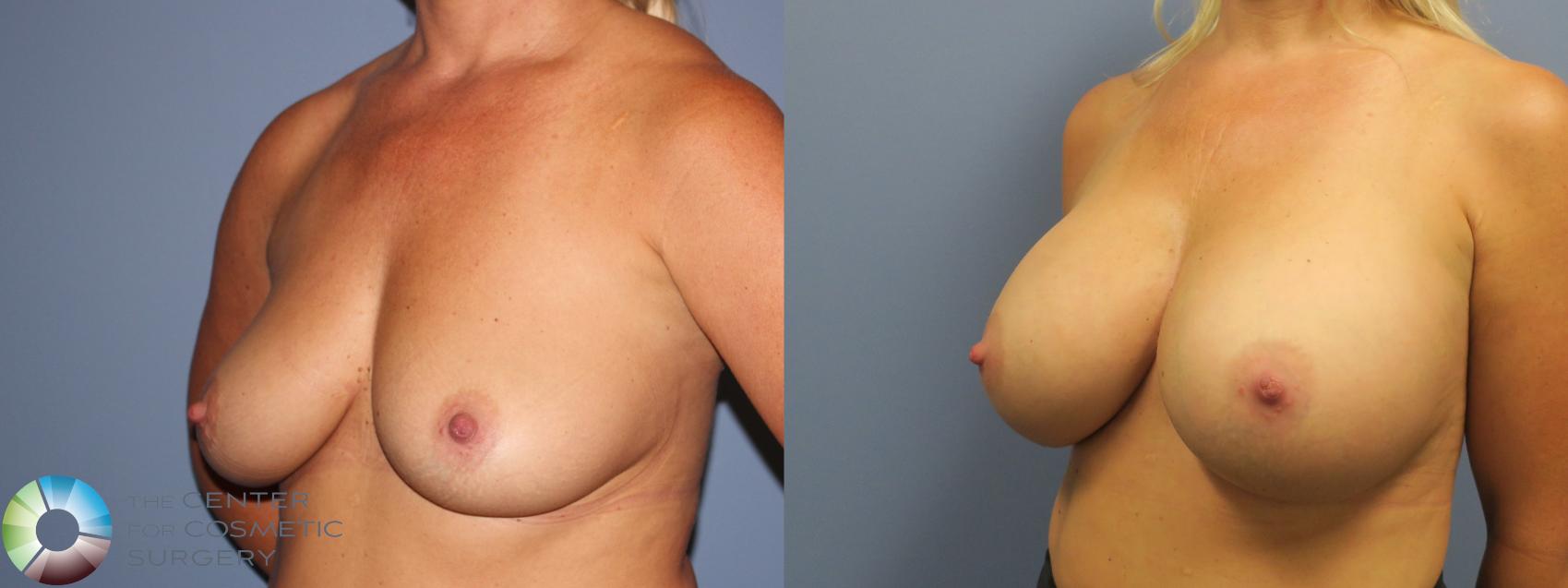 Before & After Breast Augmentation Case 11732 Left Oblique in Denver, CO