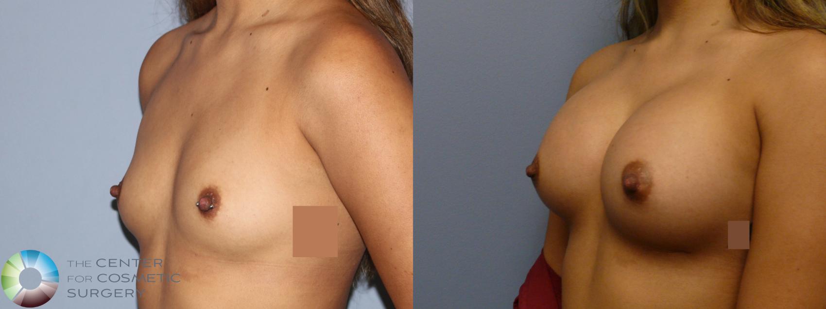 Before & After Breast Augmentation Case 11887 Left Oblique in Denver and Colorado Springs, CO