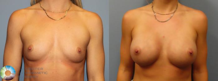 Before & After Breast Augmentation Case 11932 Front in Denver, CO
