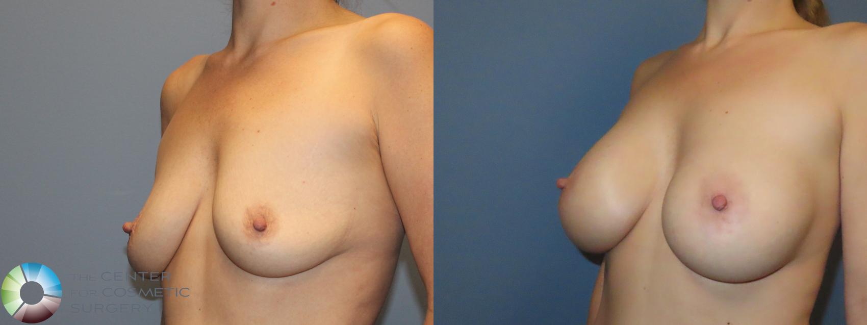 Best Denver Breast Augmentation/Motiva Implants