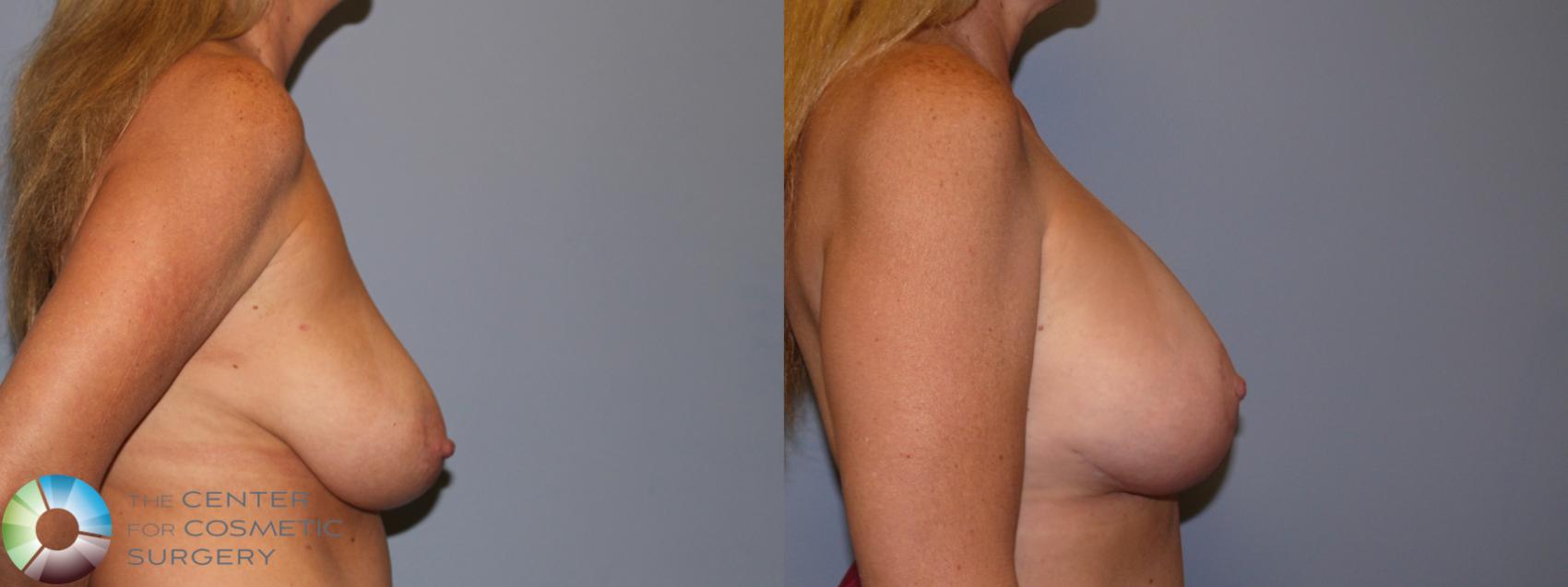 Best Denver Breast Lift/Augmentation