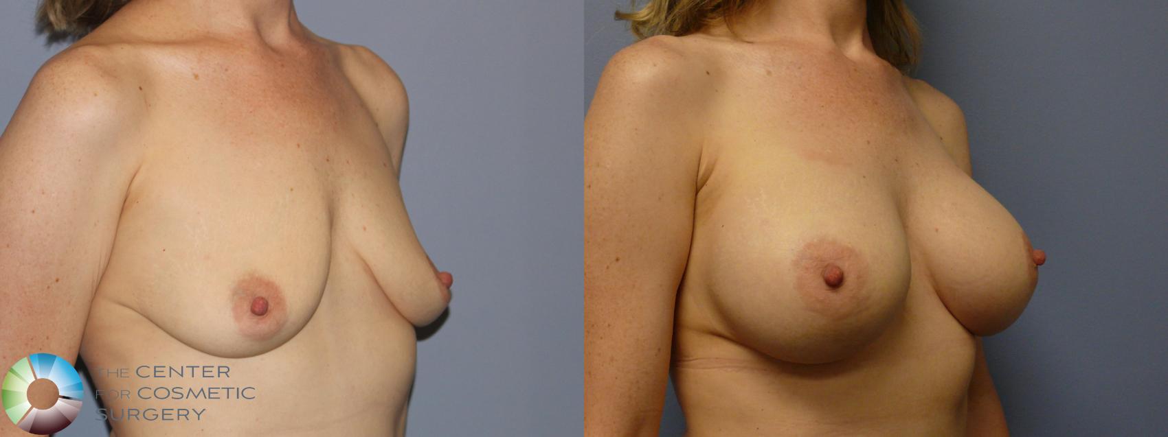 Best Denver Breast Augmentation/Implants