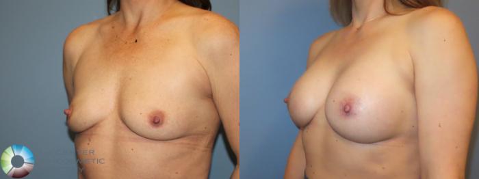 Best Denver Breast Augmentation/Implants