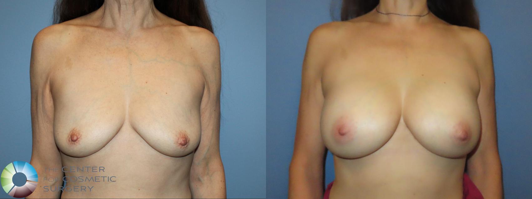 Best Denver Breast Augmentation/Implants