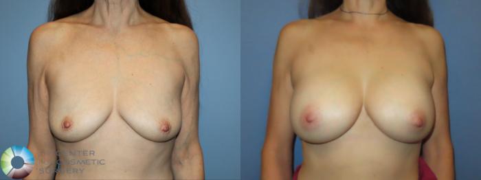 Best Denver Breast Augmentation/Implants