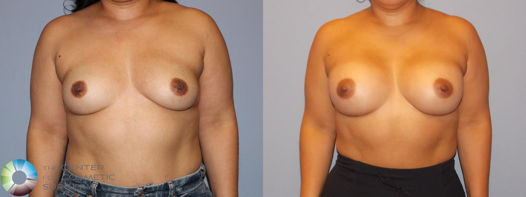 Before & After Motiva Implants® Case 12158 Front in Denver and Colorado Springs, CO