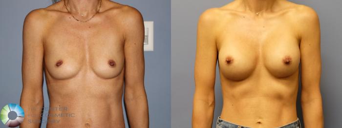 Before & After Motiva Implants® Case 12160 Front in Denver and Colorado Springs, CO