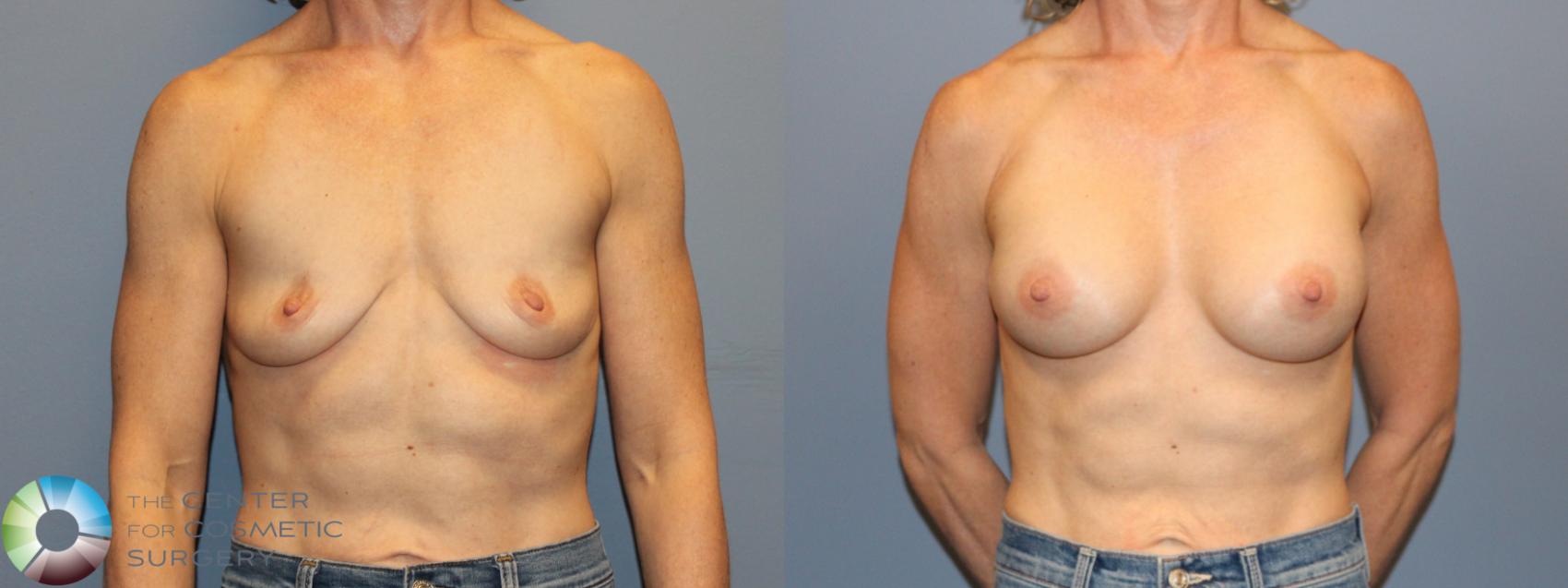 Before & After Motiva Implants® Case 12167 Front in Denver and Colorado Springs, CO