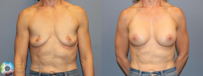 Before & After Motiva Implants® Case 12167 Front in Denver and Colorado Springs, CO