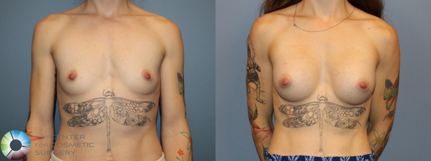 Before & After Motiva Implants® Case 12172 Front in Denver and Colorado Springs, CO