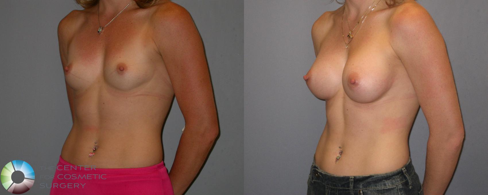 Before & After Breast Augmentation Case 123 View #1 in Denver, CO