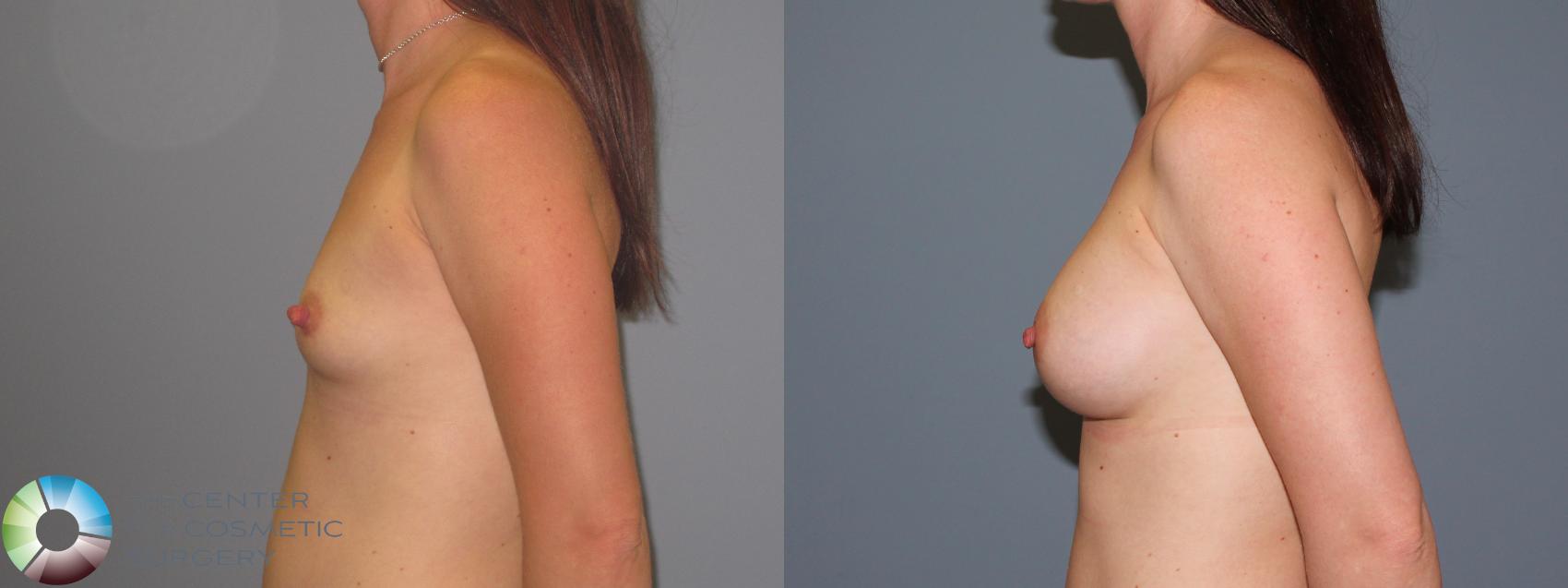 Before & After Breast Augmentation Case 486 View #3 in Denver, CO