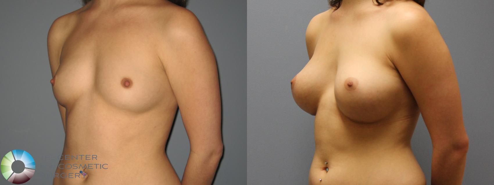 Breast Augmentation Case 493 Before & After View #1 | Golden, CO | The Center for Cosmetic Surgery