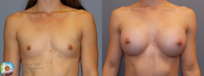 Before & After Breast Augmentation Case 758 View #1 in Denver, CO