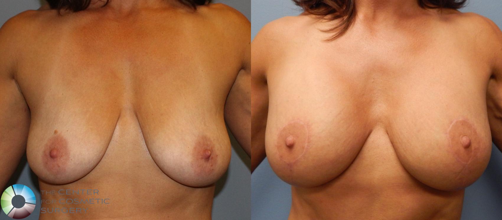 Breast Augmentation Case 892 Before & After View #1 | Golden, CO | The Center for Cosmetic Surgery
