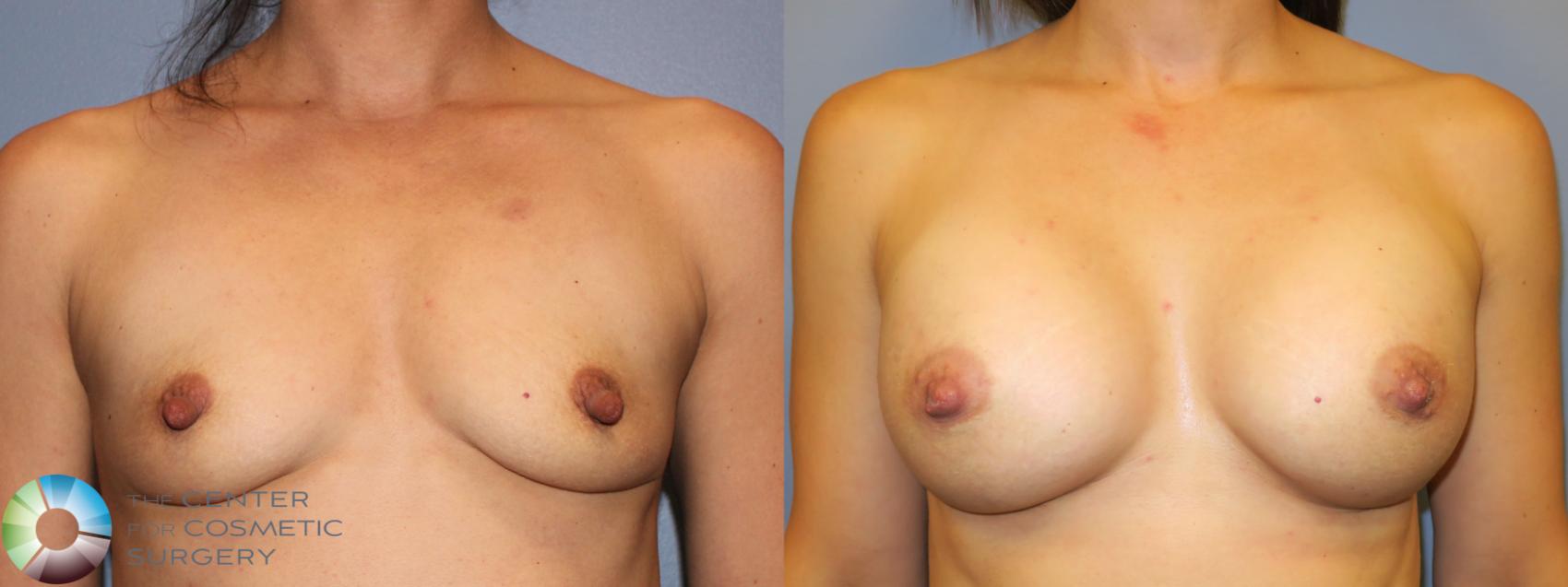 Before & After Breast Augmentation Case 911 Anterior in Denver and Colorado Springs, CO
