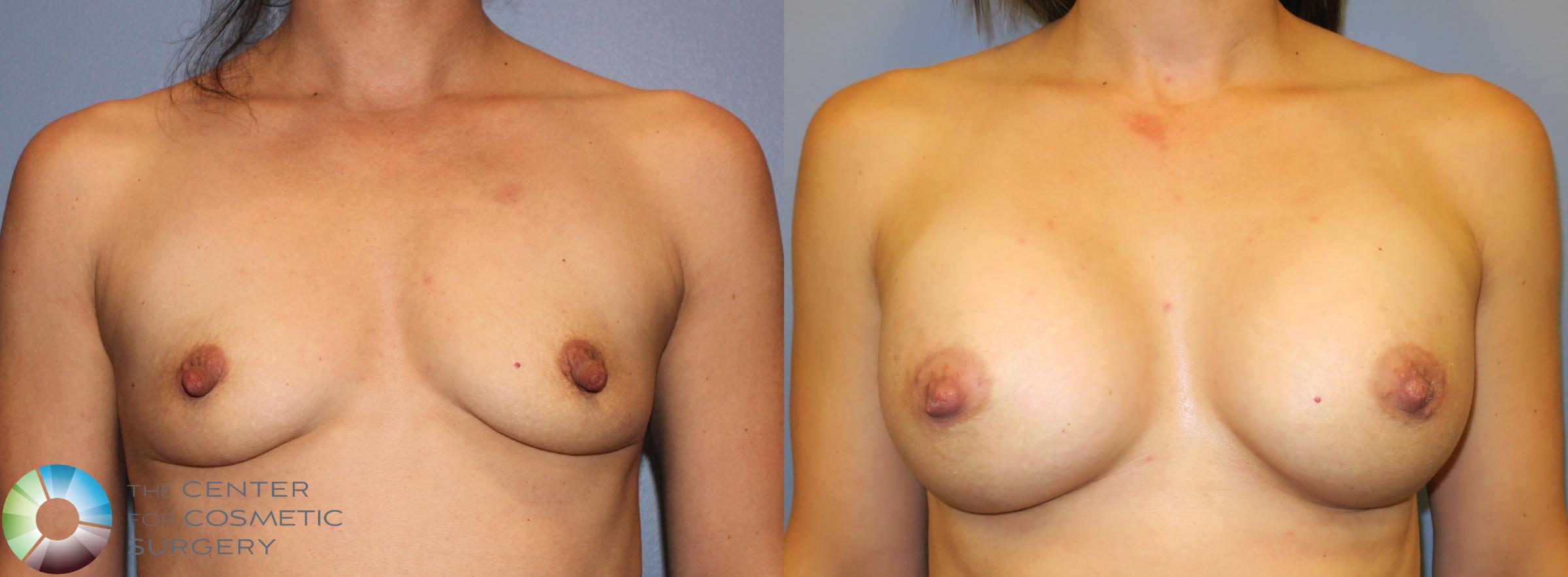 Nipple Repair Case 911 Before & After View #1 | Golden, CO | The Center for Cosmetic Surgery
