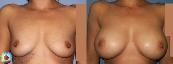 Before & After Nipple reduction Case 931 View #1 in Denver, CO