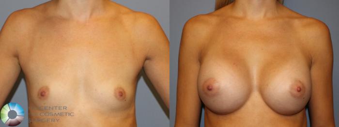 Before & After Breast Augmentation Case 934 View #1 in Denver, CO