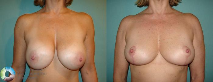 Before & After Breast Implant Removal (Explant) Case 10864 view-1 in Denver, CO