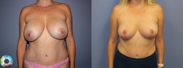 Before & After Breast Implant Removal (Explant) Case 11214 Front in Denver, CO