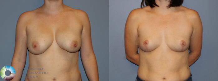 Before & After Breast Implant Revision Case 11222 Front in Denver, CO