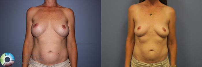 Before & After Breast Implant Removal (Explant) Case 11228 Front in Denver, CO