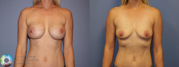 Before & After Breast Implant Removal (Explant) Case 11231 Front in Denver, CO