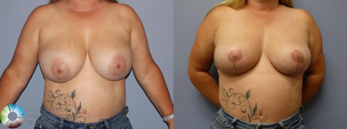 Before & After Breast Implant Removal (Explant) Case 11923 Front in Denver, CO